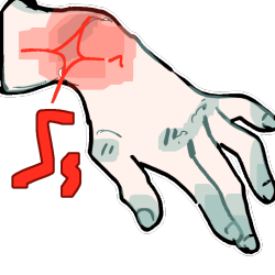 A light greyscale hand with the wrist highlighted in red, and red pain lines radiating from it.